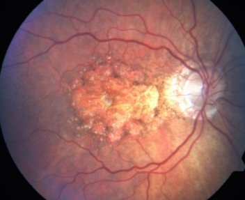 Dry AMD