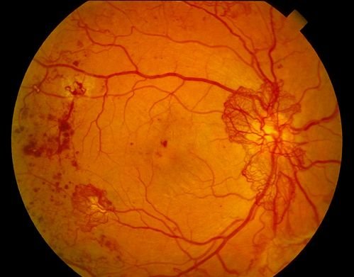 Diabetic Retinopathy