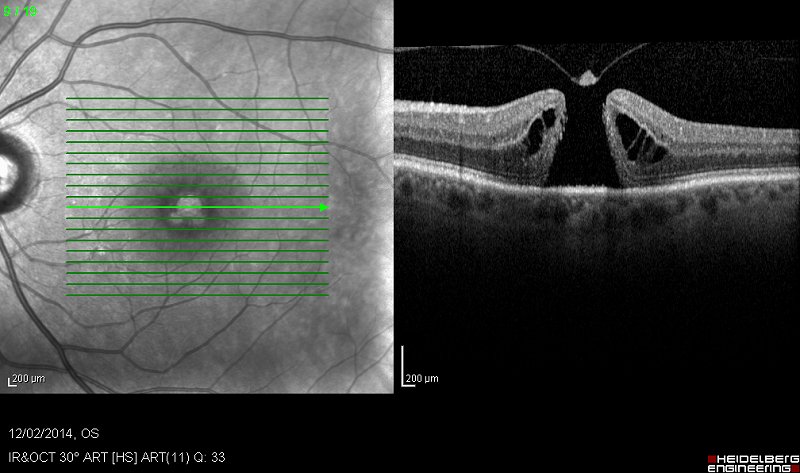 Macular Hole before Surgery