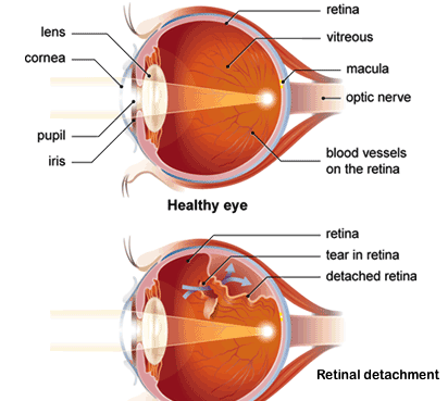 retina detachment surgery gas airplanes blindness