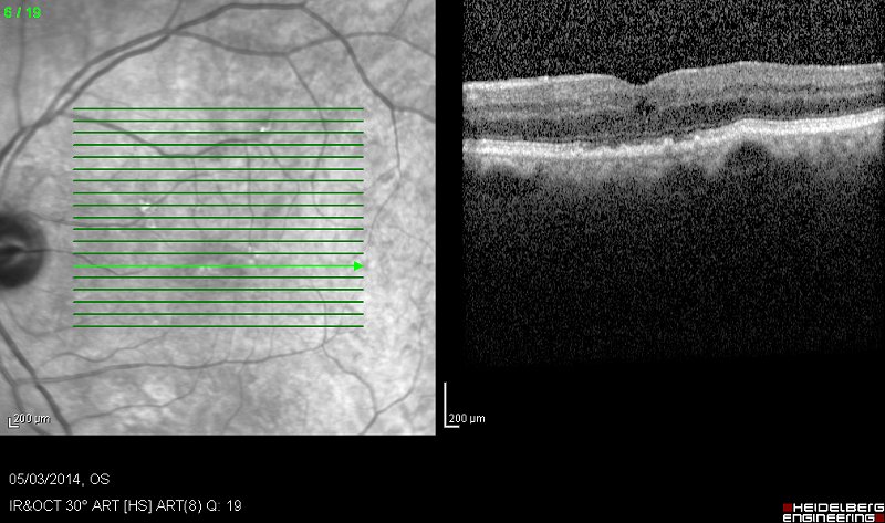 vmt ophthalmology